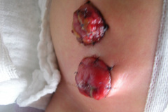 atresia-union-ileocecal-colon-hipoplasico-colostomia-doble-boca-rn-4d-10-d-2005-017