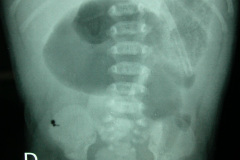 atresia-union-ileocecal-colon-hipoplasico-colostomia-doble-boca-rn-4d-10-d-2005-018