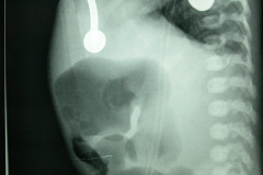atresia-union-ileocecal-colon-hipoplasico-colostomia-doble-boca-rn-4d-10-d-2005-021