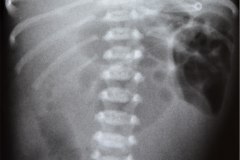 atresia-yeyuno-enterocolitis-ecn-postop-rn45d-1998-000