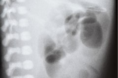 atresia-yeyuno-enterocolitis-ecn-postop-rn45d-1998-001
