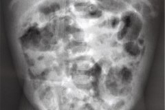 atresia-yeyuno-enterocolitis-ecn-postop-rn45d-1998-002