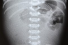 atresia-yeyuno-enterocolitis-ecn-postop-rn45d-1998-003