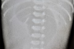 atresia-yeyuno-enterocolitis-ecn-postop-rn45d-1998-004