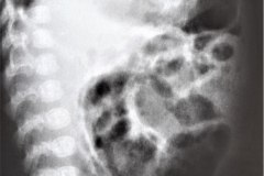 atresia-yeyuno-enterocolitis-ecn-postop-rn45d-1998-005