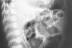 atresia-yeyuno-enterocolitis-ecn-postop-rn45d-1998-006