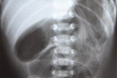 atresia-yeyuno-grasa-prevesical-2000-000