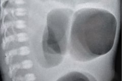 atresia-yeyuno-obstruccion-intestinal-pre-y-postop-2005-000