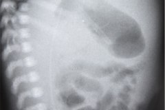 atresia-yeyuno-postop-ictericia-colestatica-1999-005
