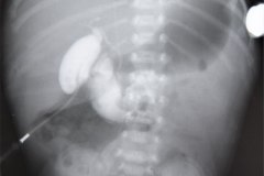 atresia-yeyuno-postop-ictericia-colestatica-1999-007