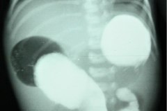 atresia-yeyuno-triple-burbuja-postop-vias-digestivas-1997-000