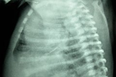 ausencia-angulo-costofrenico-anterior-cisuritis-000