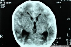 ausencia-diferenciacion-cortico-medular-ventriculomegalia-areas-hemorragicas-1995-001