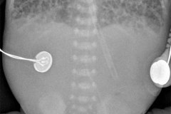 ausencia-gas-abdominal-intestino-paralitico-001