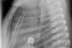 barotrauma-neumotorax-bil-a-tension-con-colapso-pulmonar-izq-enfisema-subcutaneo-tubos-torax-2009-003