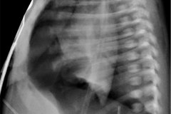 barotrauma-neumotorax-bil-a-tension-con-colapso-pulmonar-izq-enfisema-subcutaneo-tubos-torax-2009-005