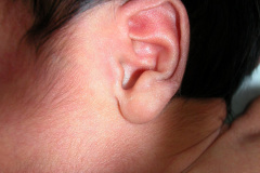 beckwith-wiedemann-macroglosia-postop-onfalocele-4d-2005-002