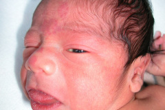 beckwith-wiedemann-macroglosia-postop-onfalocele-4d-2005-004