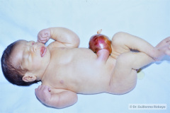 beckwitt-wideman-macroglosia-onfalocele-003