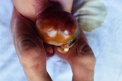 beckwitt-wideman-macroglosia-onfalocele-005