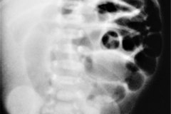 brida-peritoneal-por-adherencia-postop-de-diafragma-intestinal-1986-000