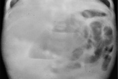 brida-peritoneal-por-adherencia-postop-de-diafragma-intestinal-1986-001