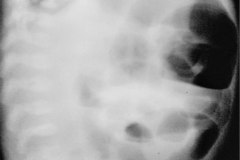 brida-peritoneal-por-adherencia-postop-de-diafragma-intestinal-1986-002