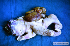 bridas-amnioticas-1985_07-016