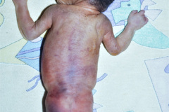 bridas-amnioticas-1997-004