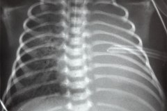 broncoaspiracion-meconio-bam-neumotorax-a-tension-atelectasia-masiva-izq-tubo-sobreinsertado-1d5d-2000-000