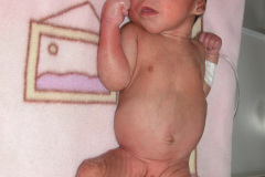 budd-chiari-ingurgitacion-veas-pared-abdominal-2009-000