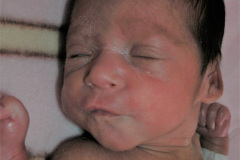 budd-chiari-ingurgitacion-veas-pared-abdominal-2009-002