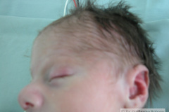 c-sindrome-trigonocefalia-de-opitz-pie-equino-cardiopatia-ap-civ-dap-2004-001