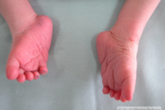 c-sindrome-trigonocefalia-de-opitz-pie-equino-cardiopatia-ap-civ-dap-2004-008