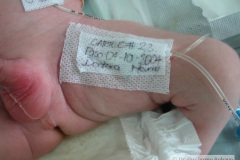 c-sindrome-trigonocefalia-de-opitz-pie-equino-cardiopatia-ap-civ-dap-2004-009