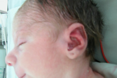 c-sindrome-trigonocefalia-de-opitz-pie-equino-cardiopatia-ap-civ-dap-2004-012