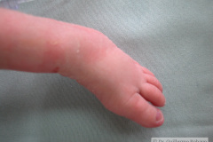 c-sindrome-trigonocefalia-de-opitz-pie-equino-cardiopatia-ap-civ-dap-2004-016