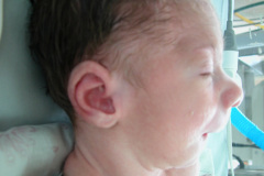 c-sindrome-trigonocefalia-de-opitz-pie-equino-cardiopatia-ap-civ-dap-2004-018