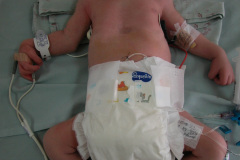 c-sindrome-trigonocefalia-de-opitz-pie-equino-cardiopatia-ap-civ-dap-2004-020