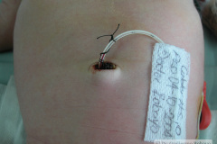 c-sindrome-trigonocefalia-de-opitz-pie-equino-cardiopatia-ap-civ-dap-2004-022