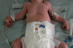 c-sindrome-trigonocefalia-de-opitz-pie-equino-cardiopatia-ap-civ-dap-2004-023