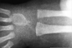 calcificacion-dorso-mano-inflitracion-de-gluconato-de-calcio-002