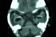 calcificaciones-periventriculare-citomegalovirus-cmv-2001-000