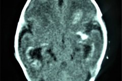 calcificaciones-periventriculare-citomegalovirus-cmv-2001-001
