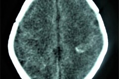 calcificaciones-periventriculare-citomegalovirus-cmv-2001-002