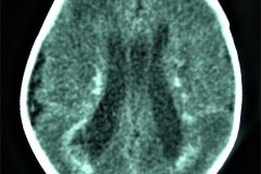 calcificaciones-periventriculare-citomegalovirus-cmv-2001-003