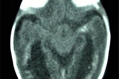 calcificaciones-periventriculare-citomegalovirus-cmv-2001-004