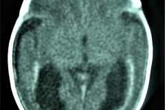 calcificaciones-periventriculare-citomegalovirus-cmv-2001-005