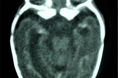 calcificaciones-periventriculare-citomegalovirus-cmv-2001-006