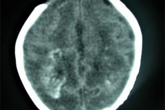 calcificaciones-periventriculare-citomegalovirus-cmv-2001-007